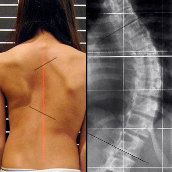 fix scoliosis to increase height
