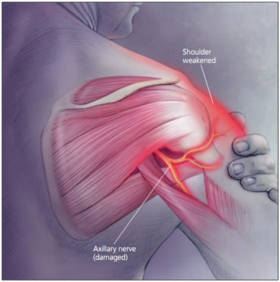 How to Relieve Nerve Pain in Shoulder and Neck