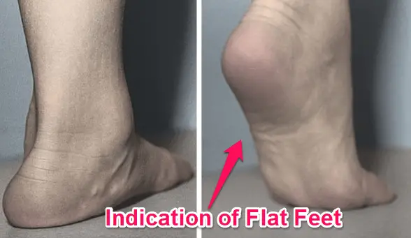 Can Flat Foot Become IPS
