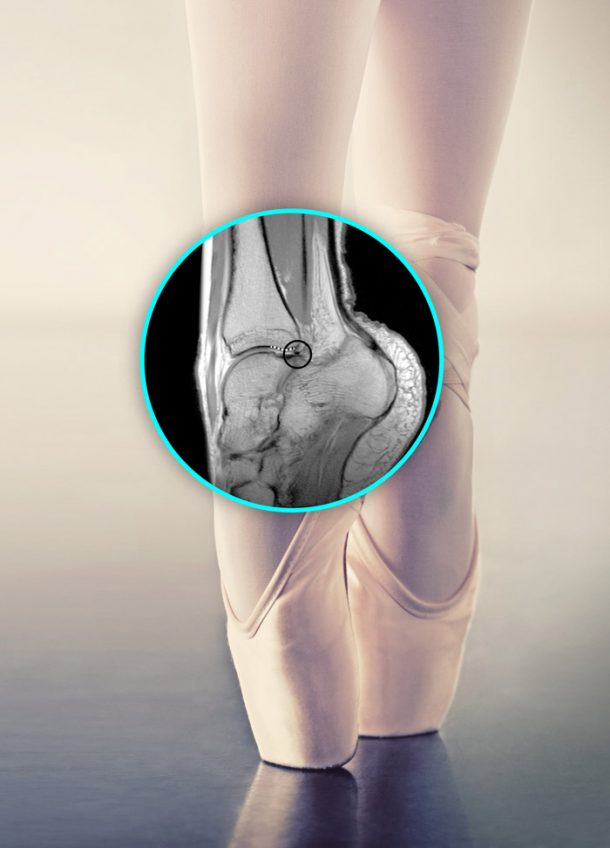 Do Ballerinas Really Stand On Their Toes? ( Long Term Effects