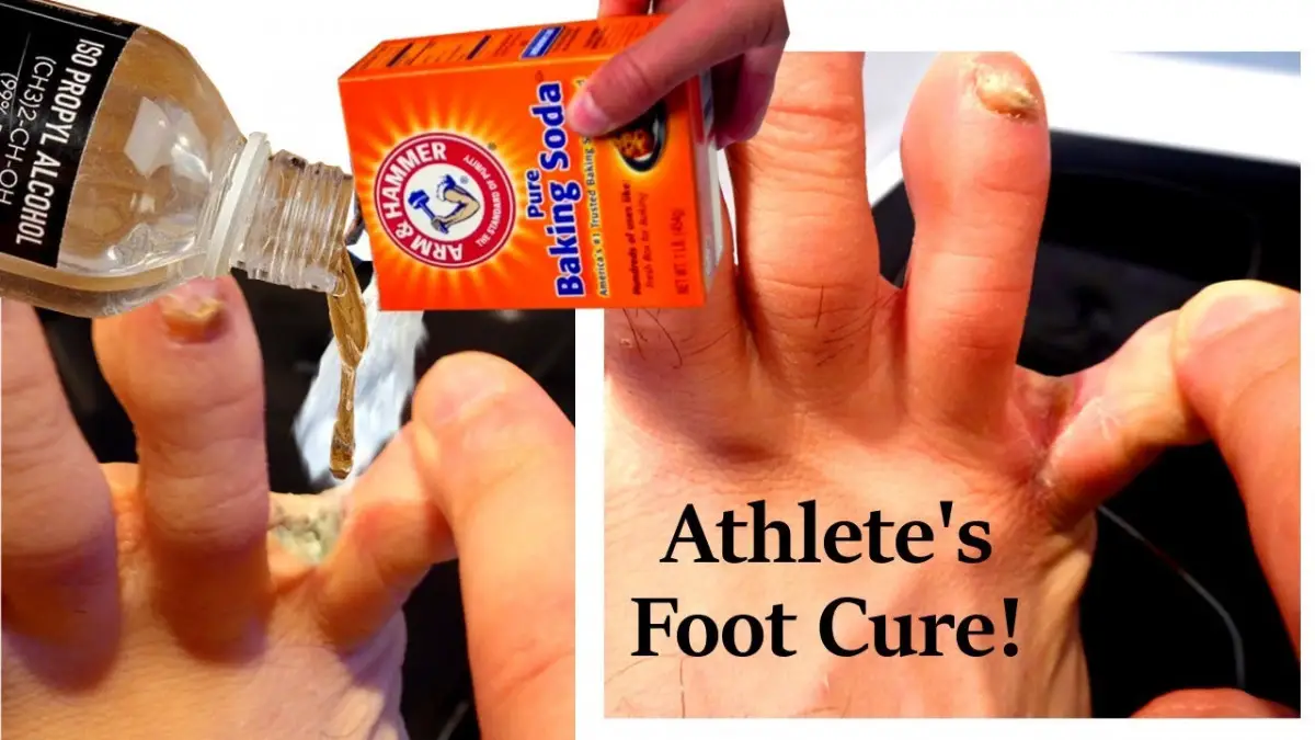 Will Hand Sanitizer Kill Athletes Foot