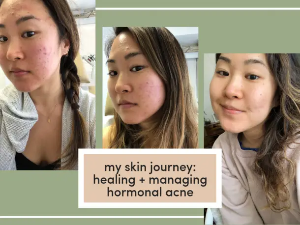 Curated visual reference: Picture Idea: Can Vitamin D Cause Breakouts