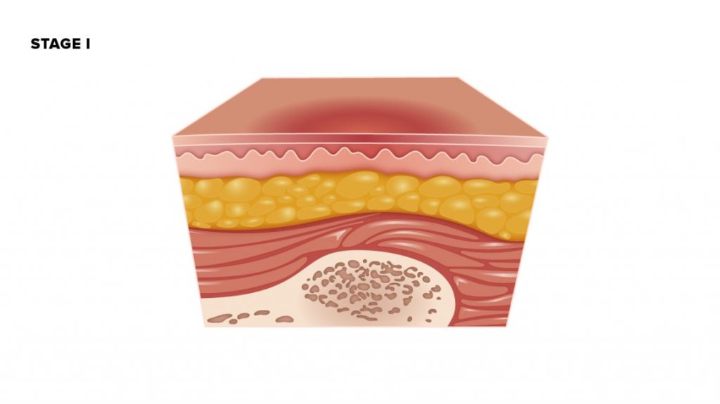 8 Good Reasons For Moist Wound Healing PostureInfoHub