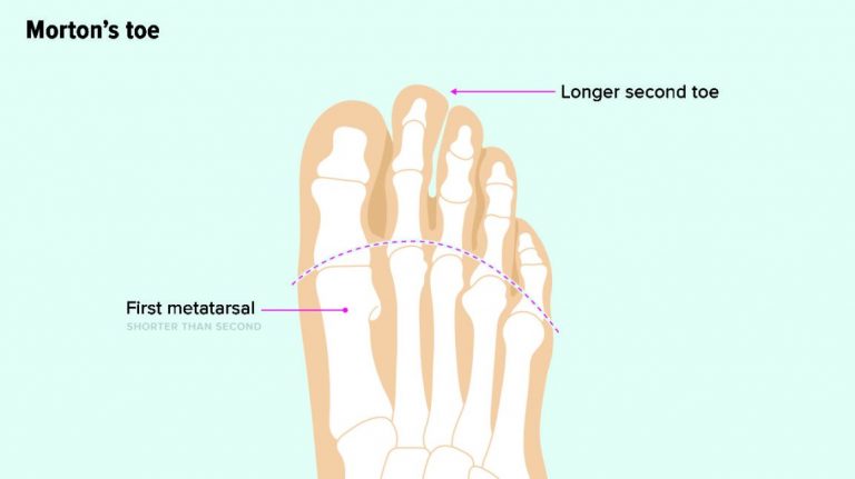 Which Toe is the Most Important? - PostureInfoHub