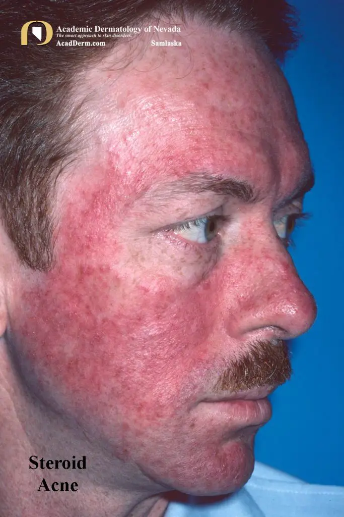 Can Steroids Cause Acne on Face